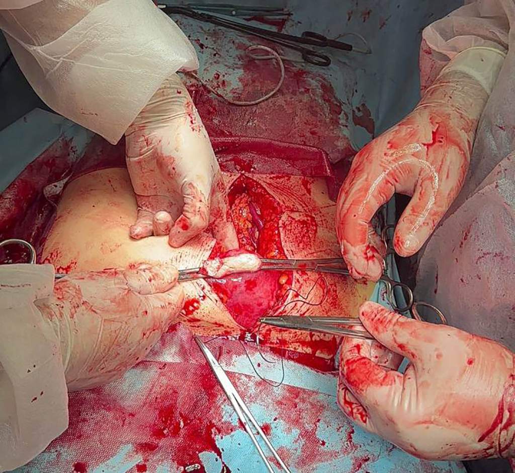 Опухоль размером с беременность: хирурги РостГМУ удалили женщине «просто» миому